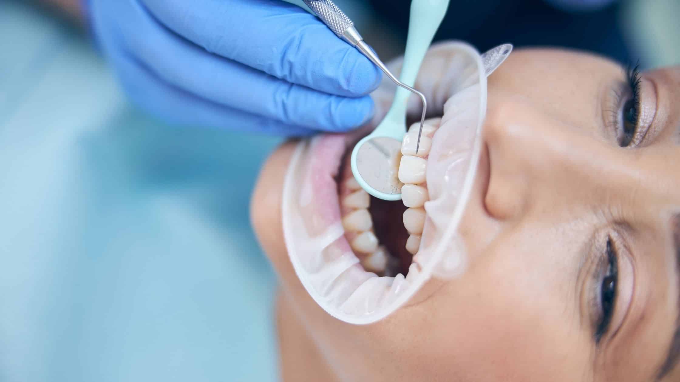 Ağız Sağlığında Detertrajın Önemi